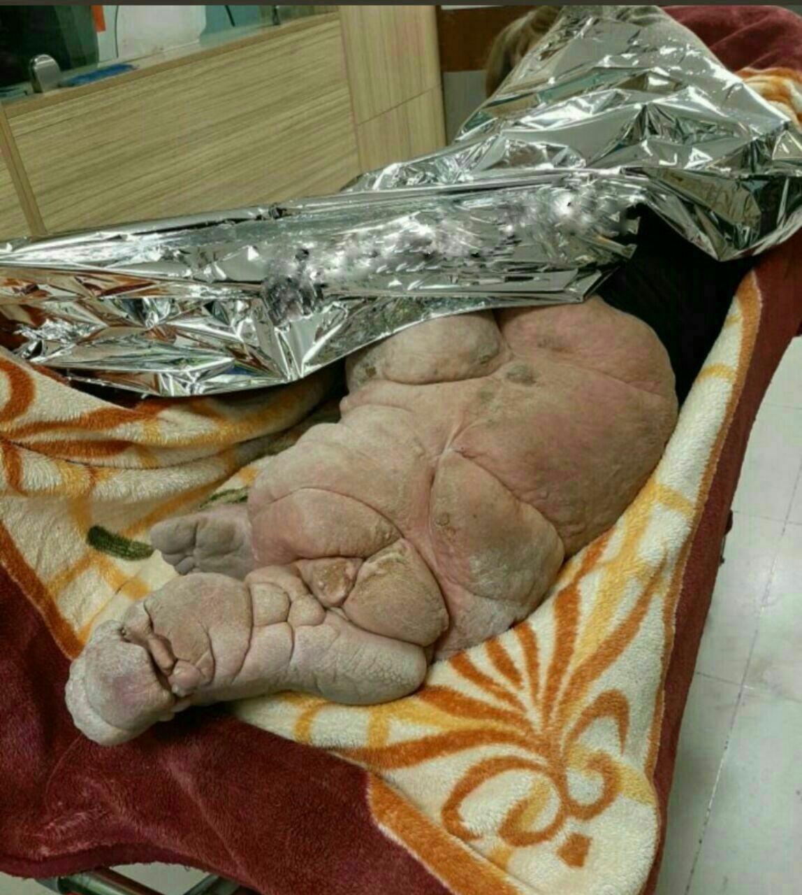 پای بیمار مبتلا به کرم انگلی در بیمارستانی در تهران + عکس