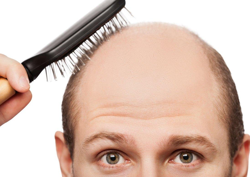 نسخه طلایی برای درمان ریزش مو