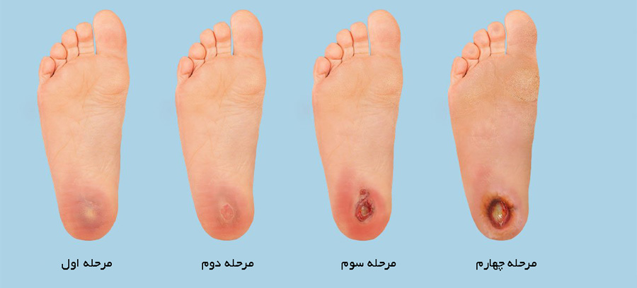  زخم دیابت و روش‌های درمان 
