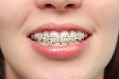 باورهای اشتباه درباره ارتودنسی
