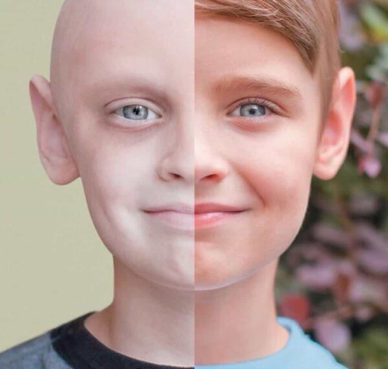 کدام کودکان  بیشتر به سرطان مبتلا می شوند؟