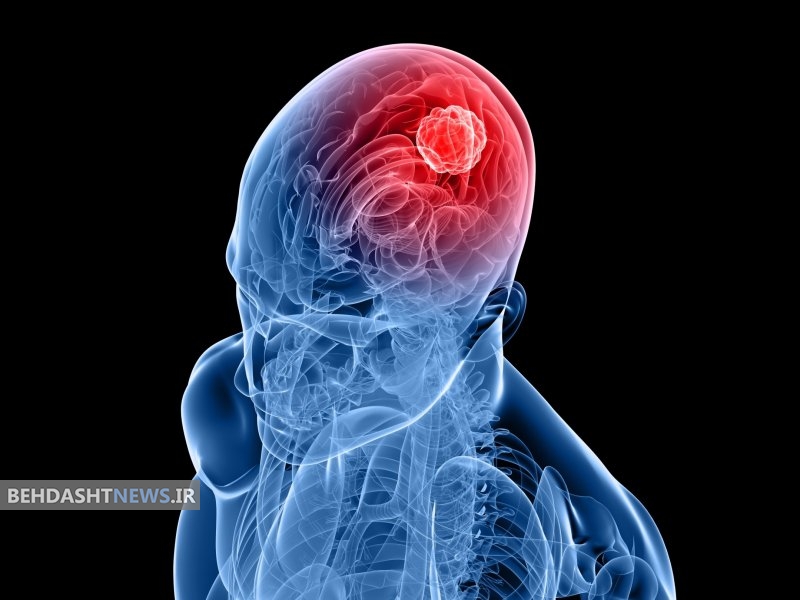  شناسایی عوامل خطرساز نوعی سرطان بدخیم مغز