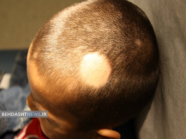 کچلی سکه ای و درمان آن