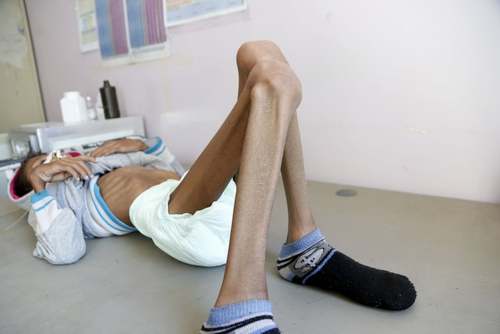 وضع وخیم کودک یمنی مبتلا به سوء تغذیه + عکس