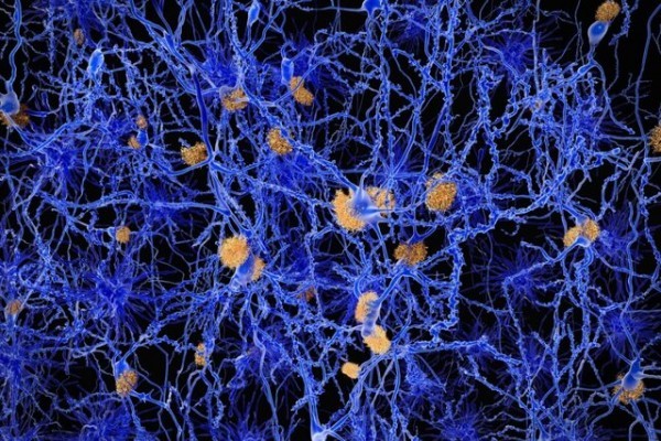   نشانه اولیه آلزایمر در مغز چیست