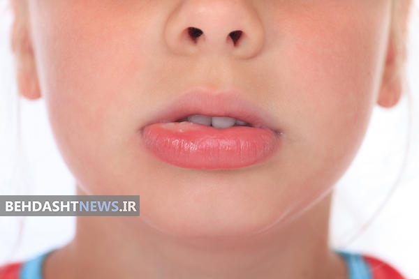 ورم بی دلیل لب ، علل و راههای درمان ورم لب 