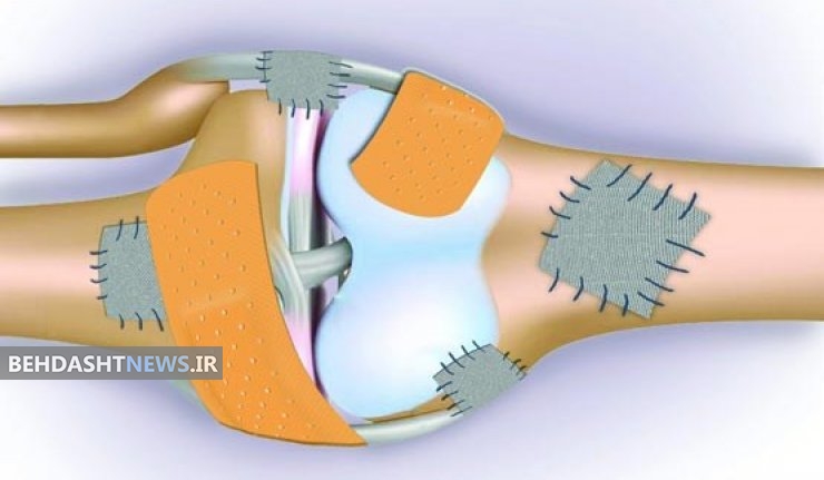 رفع پوکی استخوان به کمک طب سنتی