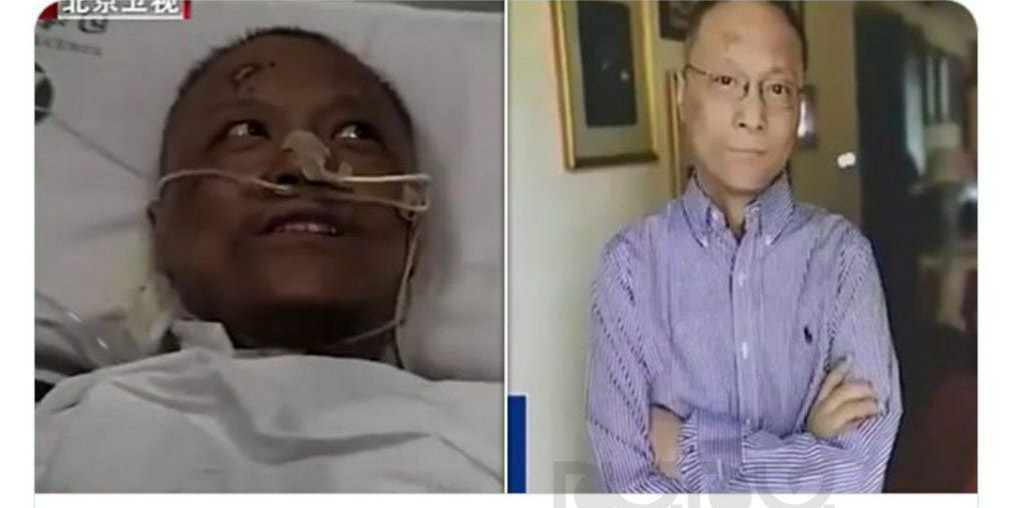 پزشک چینی مبتلا به کرونا پوست سیاهش به رنگ قبل برگشت + عکس