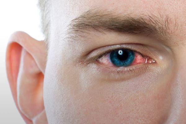 از کجا بفهمیم قرمزی چشممان نشانه ی کرونا  است یا آلرژی فصلی؟|  مصاحبه اختصاصی