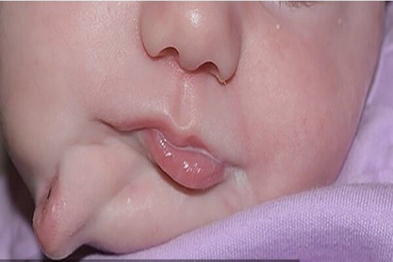  نوزادی با دو دهان متولد شد! +عکس
