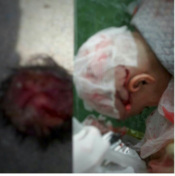 کنده شدن پوست سر کودک نجف آبادی در اثر حمله سگ + عکس