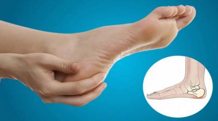  خار پاشنه پا چیست چه علائمی دارد و چگونه درمان می شود؟