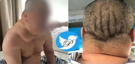 عاقبت الکل خوری مرد چینی پس از ۴ دهه! + عکس