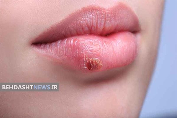 چه چیزهایی تبخال را بیدار می کنند