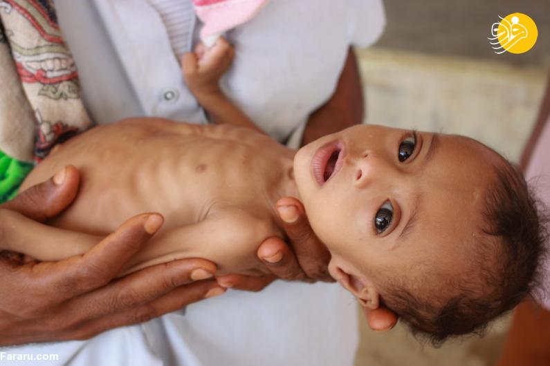 سوءتغذیه شدید و ناراحت کننده کودک یمنی + عکس