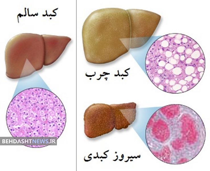 کبد چرب؛ یک بیماری مزمن ‌پررو+ دستورالعمل غذایی