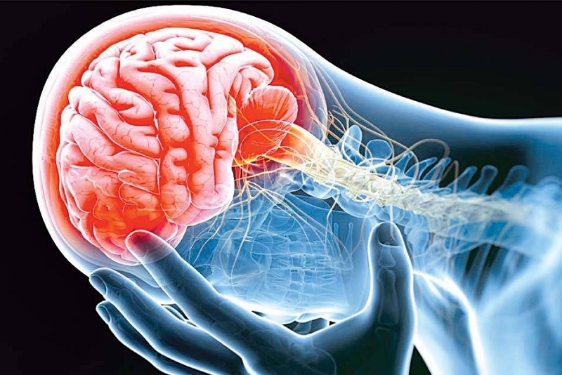 خطر ابتلا به سکته مغزی در کدام گروه بالاتر است؛ مبتلایان به کرونا یا آنفلونزا؟