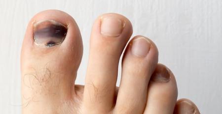  5 دلیل سیاه شدن ناخن انگشت پا