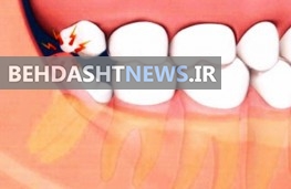 چرا دندان عقل داریم؟ 