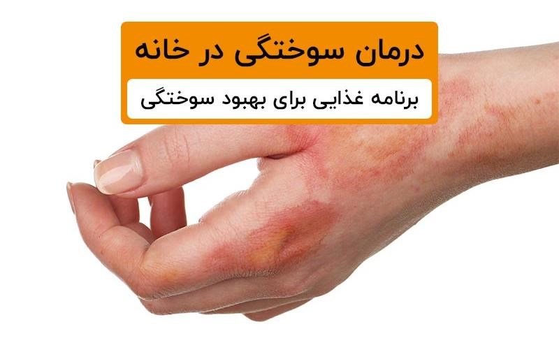 درمان سوختگی در خانه + برنامه غذایی برای بهبود سوختگی
