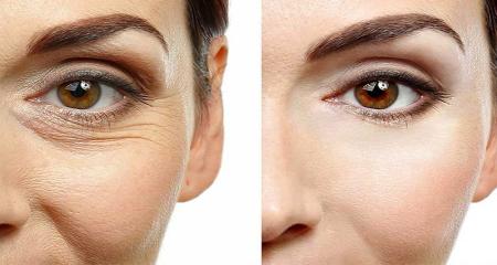 روش های رفع چروک، تیرگی و پف دور چشم