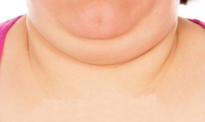  چگونه از غبغبم خلاص شوم؟