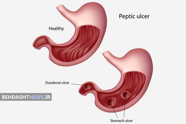  مقابله با زخم معده با پرهیزات غذایی