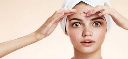 چگونه جوش صورت را درمان کنیم؟