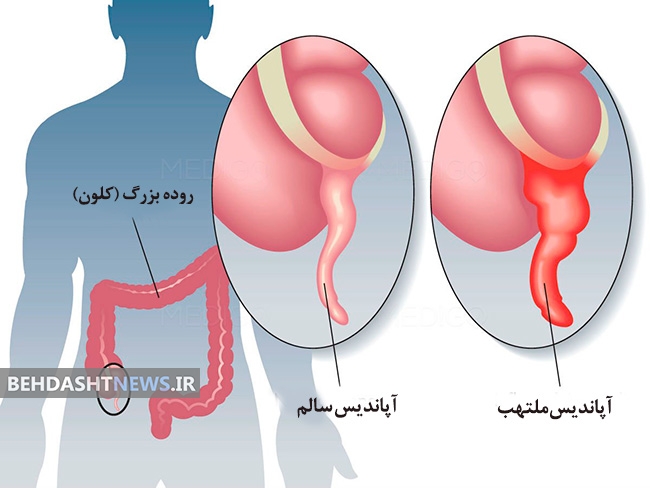 آپاندیسیت ، علل وعلائم
