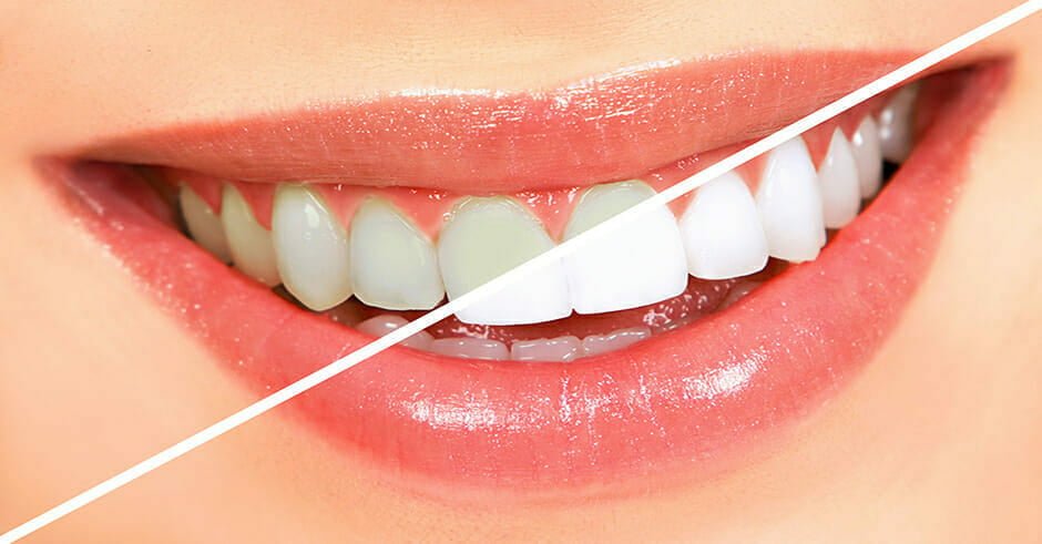 بهترین روش برای داشتن دندان های سالم