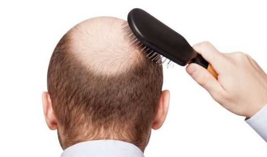 ترفندهایی برای جلوگیری از ریزش مو/ ریزش مو در جوانان 50 درصد زمینه ژنتیکی دارد