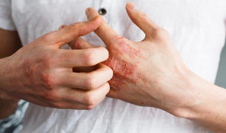 معرفی ۷ نوع اگزما 
