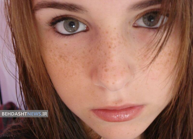 باوری غلط درباره لکه‌های پوستی