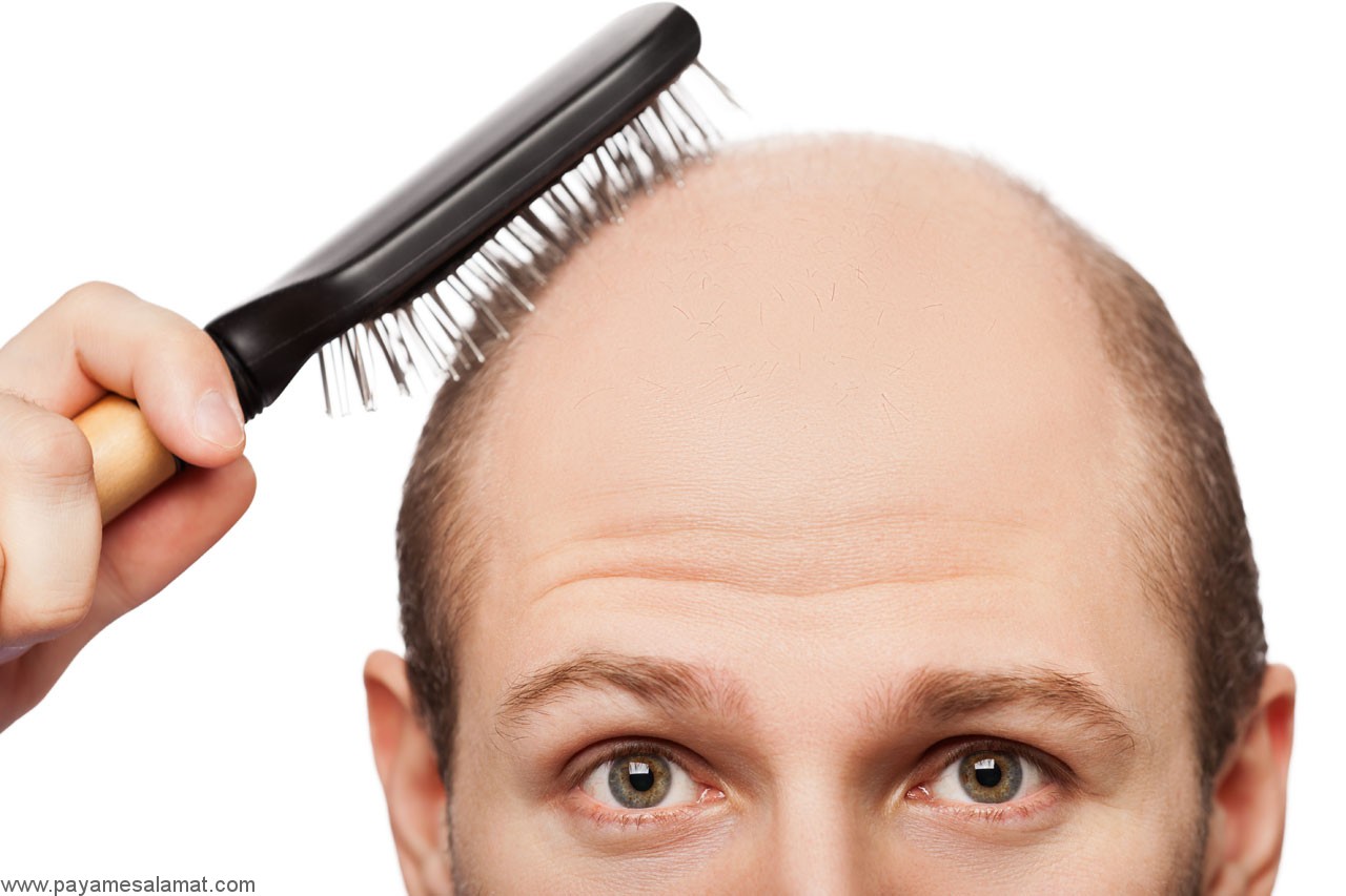 پنج غذای مؤثر در کنترل ریزش موی ارثی