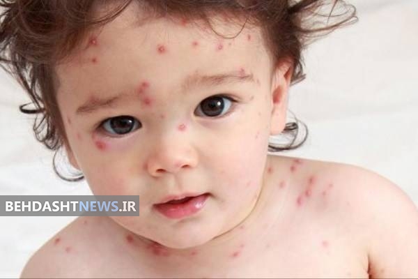  آبله مرغان چه علائم و نشانه هایی دارد