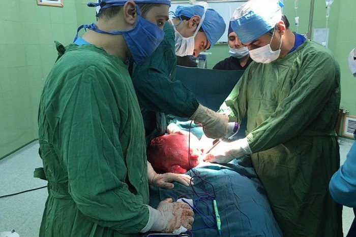 خارج کردن توده 8.5 کیلوگرمی از شکم یک بیمار! +عکس