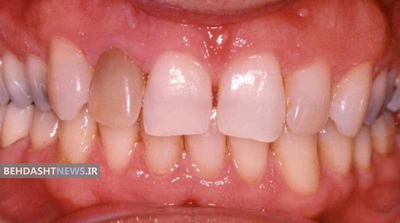 مقصر اصلی لکه دار شدن دندان چیست؟