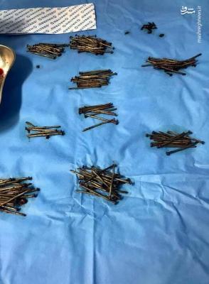 انبوه میخ در شکم یک مرد عربستانی! +عکس