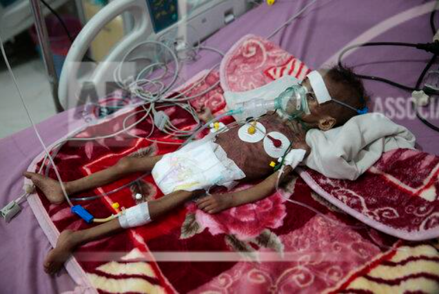 سوءتغذیه و وضعیت تأثرآور دختربچه یمنی + عکس