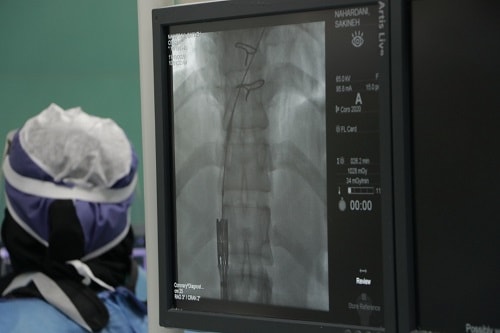 انجام نخستین عمل کارگزاری دریچه قلب بدون نیاز به جراحی در این بیمارستان