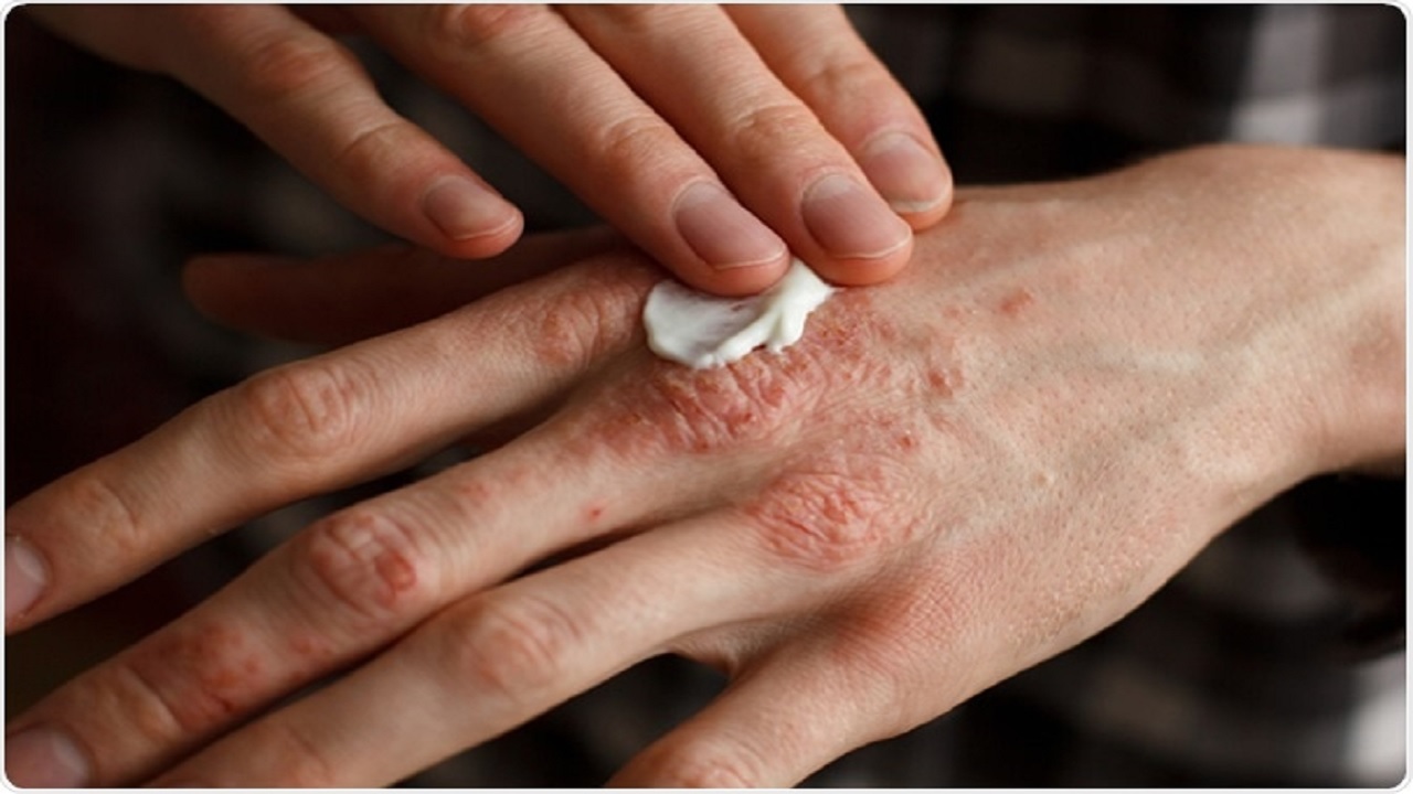  6 راهکار ساده برای درمان اگزمای پوستی