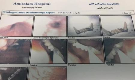 بیرون آوردن جسم خارجی از معده بیمار در مجتمع بیمارستانی امیراعلم+ عکس