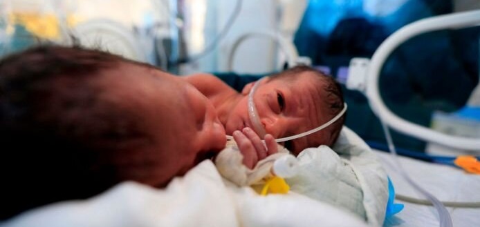 بار دیگر تولد دوقلوهای به هم چسبیده + عکس 