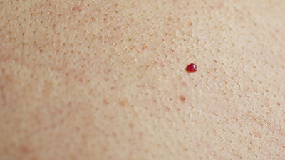  آن چه باید درباره خال‌های قرمز بدانید