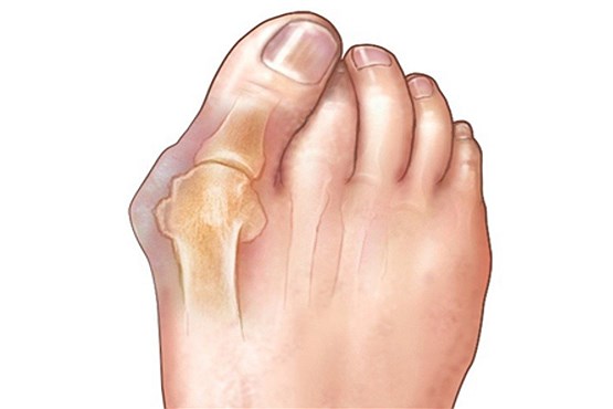 انحراف انگشت شست پا را چگونه درمان کنیم؟  