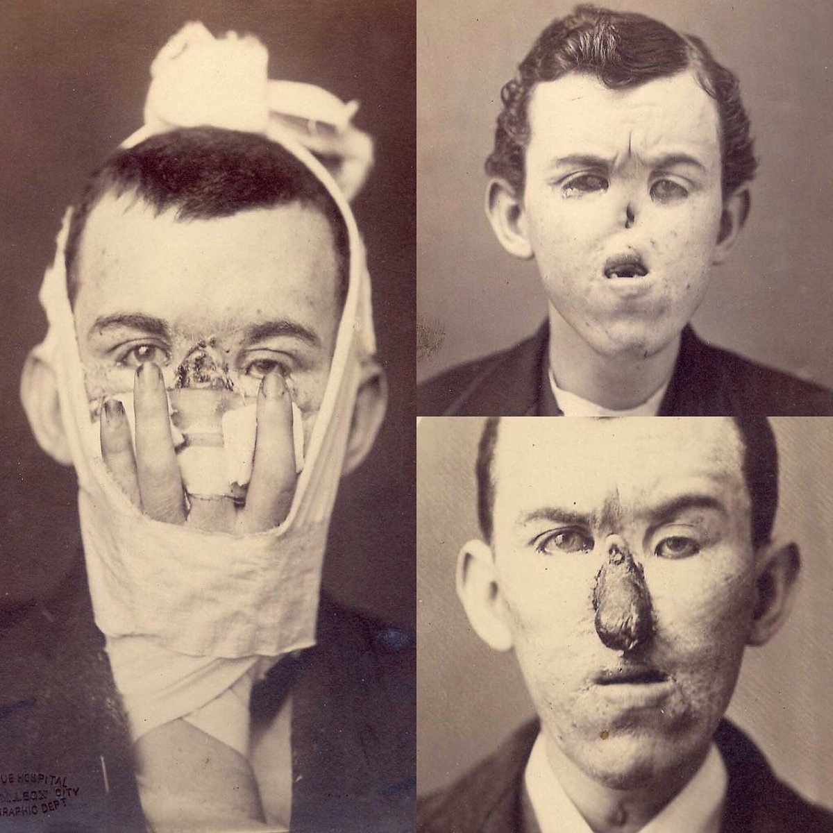 وقتی پزشکان انگشت را جای بینی پیوند زدند! + عکس