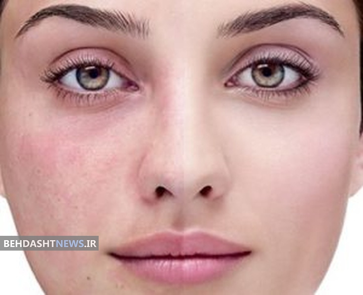 آشنایی با انواع لکه های پوستی و دلایل بروز آن ها 