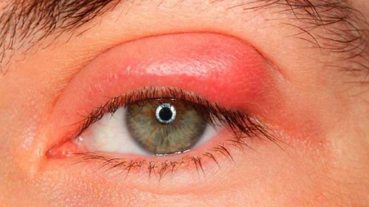 4 بیماری مرتبط با چشم و علائم آن‌ها