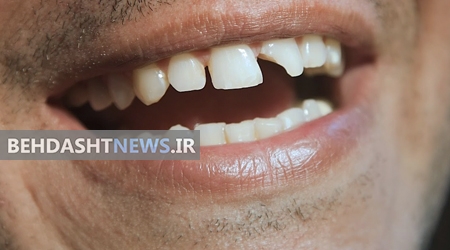 چرا دندان می شکند؟