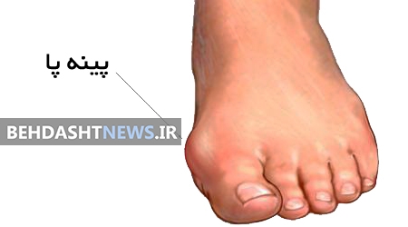 علل پینه پا و درمان آن